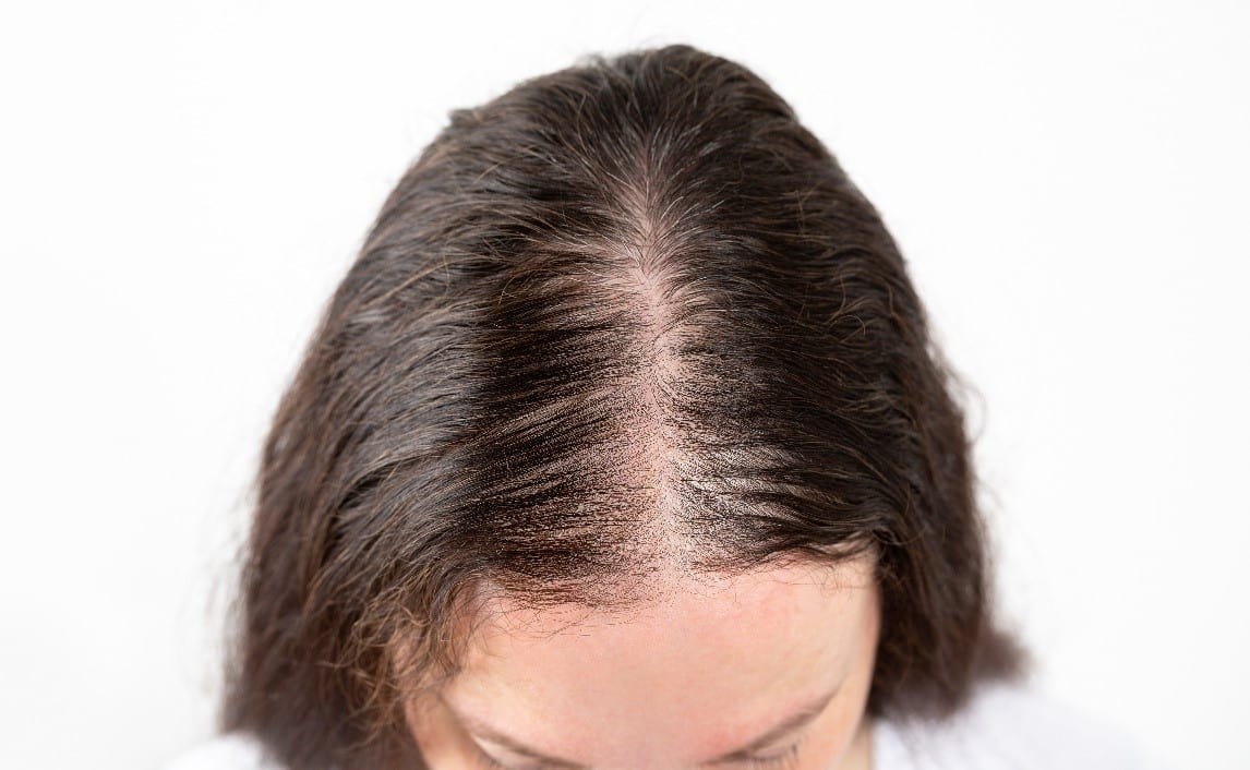 Bald Spots to Gorgeous Locks: A New Hope for Hair Repair